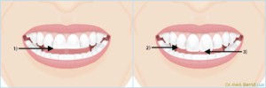 Folgen des Bruxismus - Zahnarztpraxis im Zerbster Zentrum - Zahnarzt Dr. med. Bernd Lux.