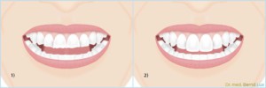 Irreversible Behandlung einer Craniomandibulären Dysfunktion - Zahnarztpraxis im Zerbster Zentrum - Zahnarzt Dr. med. Bernd Lux.