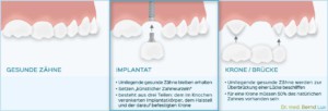 Unterschied Implantat zu Krone/Brücke - Zahnarztpraxis im Zerbster Zentrum - Zahnarzt Dr. med. Bernd Lux.