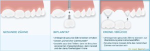 Unterschied Krone/Brücke zu Implantat - Zahnarztpraxis im Zerbster Zentrum - Zahnarzt Dr. med. Bernd Lux.